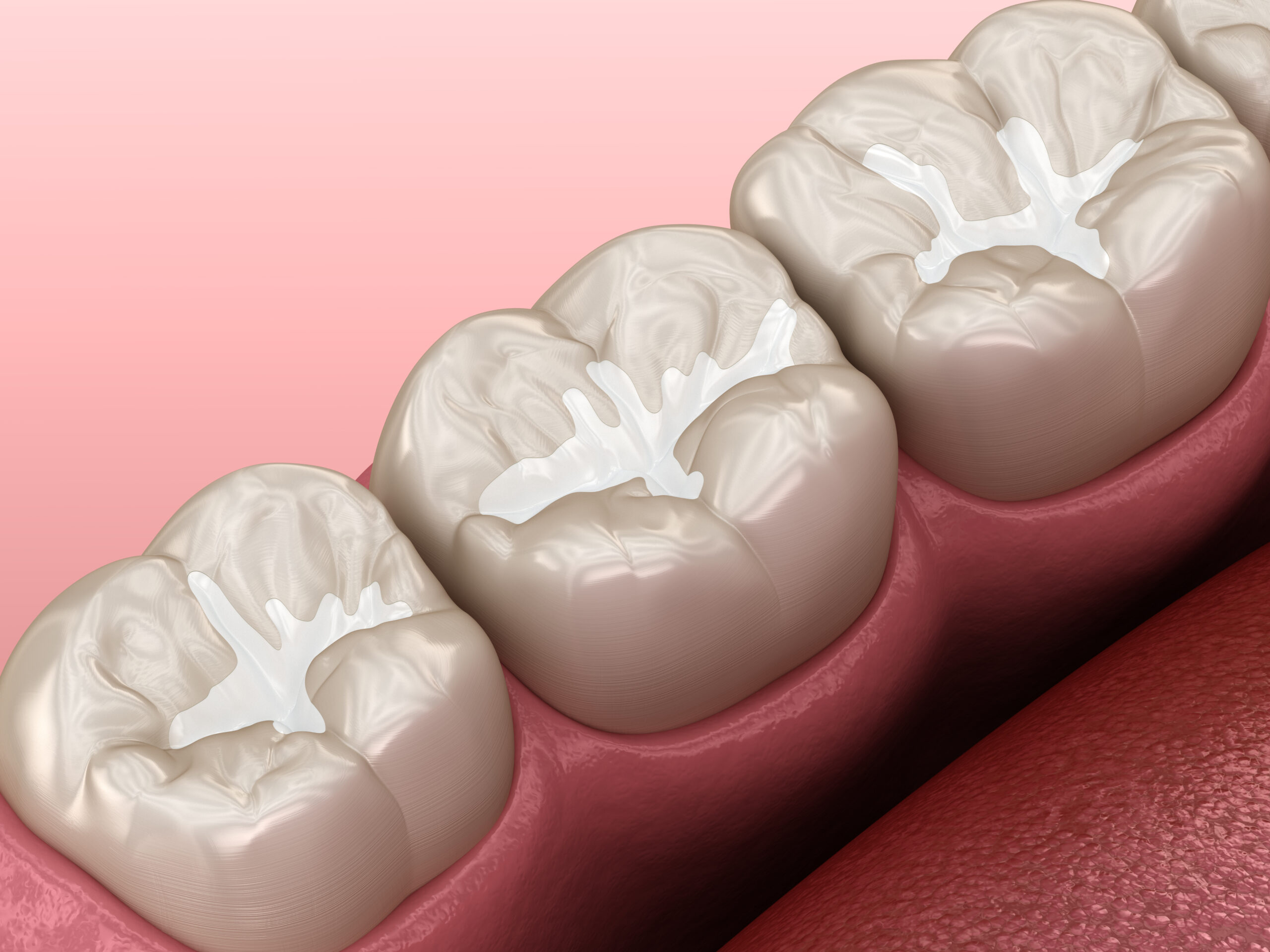 Molar Fissure dental fillings, Medically accurate 3D