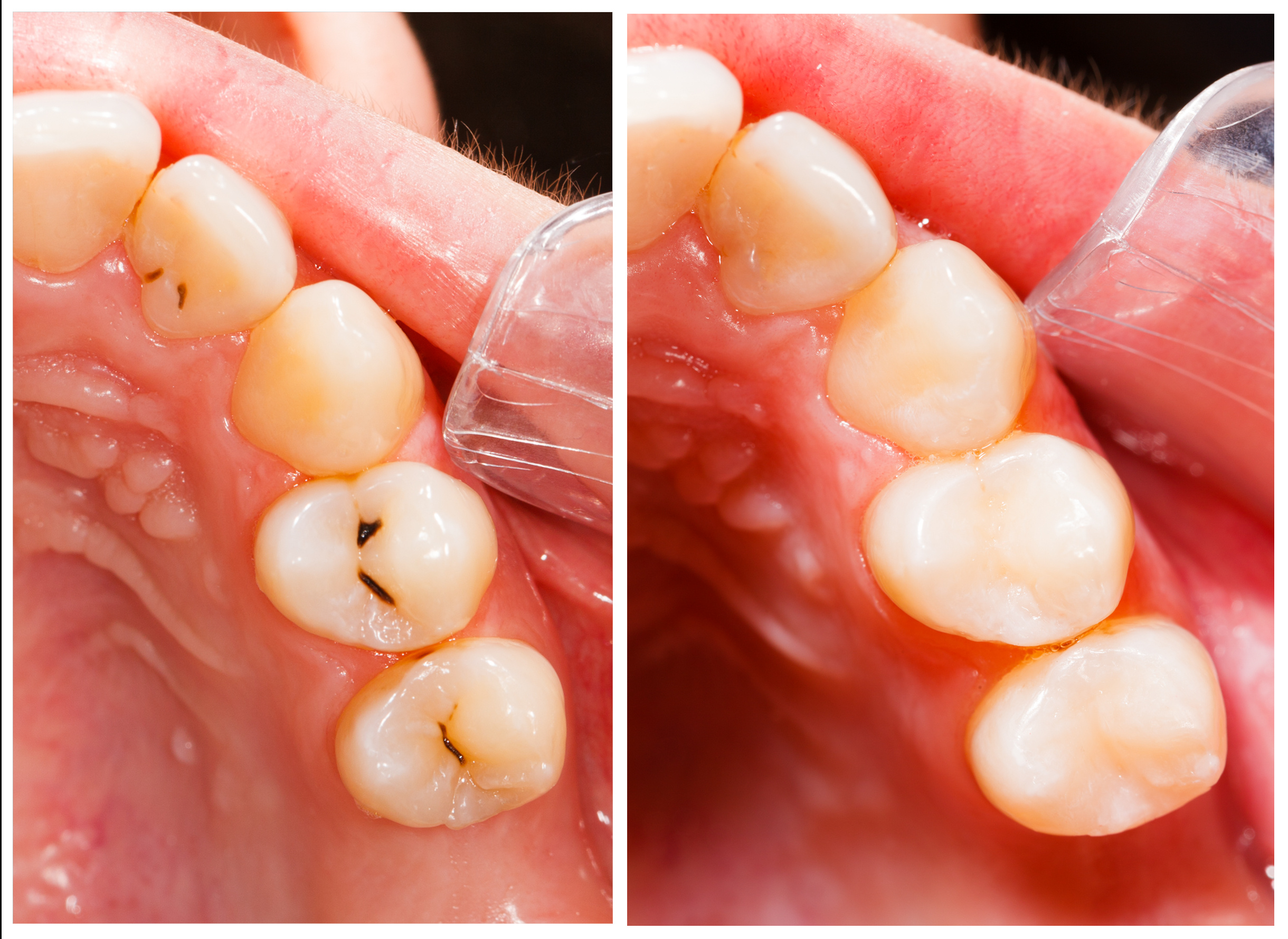 Teeth before and after treatment - dental composite filling.